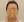 PRP自體脂肪移植（自體脂肪填補＋高濃度血小板血漿） — 術後 (42天) · The CL Clinic