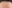 額縮小術（生え際下げ・ヘアライン下降術） — ザフィックス美容外科クリニック