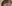 Forehead Lift (brow lift, commonly endoscopic) — Uri Plastic Surgery Clinic