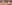 鼻尖形成術（自家軟骨移植） — コード美容外科クリニック