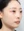 太阳穴自体脂肪填充 — 术后 (28天) · Lively医美诊所