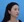 Ultracol (PDO microsphere collagen stimulator injection) — after · Gangnam BB Clinic