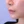 ศัลยกรรมยกริมฝีปากบน (Lip Lift) — ก่อนทำ (7วัน) · ไฮบอม ศัลยกรรมพลาสติก