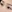 Partial incision double eyelid surgery — Yellow Plastic Surgery Clinic