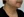 Neck wrinkle Botox (platysma band Botox / Nefertiti lift) — before (14days) · Yeonse Felice Women's Clinic