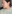 Double chin liposuction (submental liposuction) — Il Gong Gong Plastic Surgery Clinic