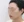 皮質骨切除術（下顎外板骨切り） — 術後 (60日) · アイルミ美容外科クリニック
