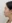 Nasal osteotomy (nasal bone narrowing) — RU Plastic Surgery Clinic