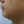 Surfect Lifting (4MHz monopolar RF lifting) — before (90days) · Only Lift Clinic