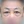 内視鏡下眉毛挙上術（内視鏡ブローリフト） — 術前 (30日) · プレジャー美容外科クリニック