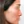 Nose tip filler — after · Erne Clinic