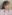 糸リフト（スレッドリフト） — ジャスト美容外科クリニック