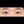 medial epicanthoplasty (inner corner opening) — after (7days) · AB Plastic Surgery & Skin Clinic