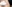 裏ハムラ法（経結膜的眼窩脂肪移動術） — プレジャー美容外科クリニック