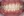 จัดฟันเฉพาะส่วนด้านใน 2D (2D lingual partial braces) — ก่อนทำ (112วัน) · คลินิกทันตกรรม Lucent