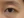 Eyelid filler (upper eyelid hollowing correction) — before (14days) · Wow Plastic Surgery