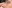 Ptosis Correction (levator surgery / eye-shape correction) — Wonjin Plastic Surgery Clinic