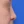ผ่าตัดแก้ไขภาวะลิ้นจมูกตีบ/ยุบ (Nasal valve stenosis) — ก่อนทำ (14วัน) · คลินิกโคบิจู