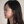 Nasal tip augmentation with donor (acellular) dermal matrix — before (30days) · Nabi Plastic Surgery Clinic