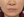 JUVGEN (autologous dermal regeneration / collagen-induction injection) — after (14days) · Saeroun Plastic Surgery