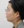 ฉีดสลายไขมันหน้า (เมโสแฟตแก้ม) — ก่อนทำ · ศูนย์ศัลยกรรม Zero - สาขาชินซา