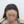 Scalp hair transplant — after (2days) · Vance Mosae Clinic