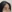 額リフト（前額リフト） — エックスオー美容外科クリニック