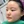 แก้จมูกบานแบบไม่ผ่าตัด (ร้อยไหม/ฉีด) — ก่อนทำ · คลินิก U