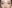 revision eyelid surgery (secondary blepharoplasty) — Luho Plastic Surgery Clinic