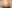 団子鼻修正（鼻尖縮小術） — ヒート美容外科クリニック