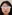 Nasal Tip Plasty with Autologous Cartilage — Uri Plastic Surgery Clinic