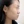 โบท็อกซ์กราม (ฉีดลดกราม) — ก่อนทำ (90วัน) · คลินิกศัลยกรรมพลาสติกบาตัง