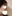 団子鼻修正（鼻尖縮小術） — アーバン美容外科クリニック