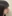 鼻尖形成術（自家軟骨移植） — アウラ美容外科クリニック