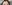 額（おでこ）のヒアルロン酸注入 — フルルン美容外科クリニック