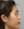 Thread embedding acupuncture lift (Korean-medicine 'maeseon' acupoint thread lift) — before · Roa Clinic