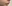 人中短縮（リップリフト） — ハイボム美容外科クリニック