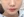 ฉีดสเต็มเซลล์ (Stem cell injection) — หลังทำ (30วัน) · คลินิก AB Aesthetic Surgery