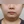 ELSA 超声波溶脂吸脂（面部溶脂） — 术前 (90天) · A Top医美诊所