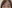 Natural adhesion double eyelid surgery (non-incisional adhesion method) — I-Fit Plastic Surgery Clinic