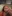 revision eyelid surgery (secondary blepharoplasty) — DA Plastic Surgery Clinic