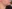 Double chin liposuction (submental liposuction) — Seoul During Clinic
