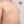 女性化乳房手術（男性の乳腺切除） — 術後 (13日) · ザ・美容外科