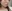 人中短縮（リップリフト） — ハイボム美容外科クリニック