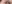 Ptosis Correction (levator surgery / eye-shape correction) — Uri Plastic Surgery Clinic