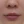 โบท็อกซ์ร่นร่องริมฝีปาก (Lip Flip ทำให้ร่องใต้จมูกดูสั้นลง) — หลังทำ (7วัน) · คลินิก Younme