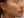 側臉頰填充（玻尿酸填補側臉頰凹陷） — 術前 · Cheongdam Dear 醫美診所