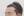 Forehead reduction (hairline lowering surgery) — after (12days) · Goyu Plastic Surgery Clinic