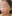 目の下の脂肪注入（くぼみ・クマ治療） — プレジャー美容外科クリニック