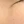 จี้หูด / กำจัดหูด (CO2 laser, จี้เย็น) — หลังทำ (14วัน) · โอริเฟซ ซองโด คลินิกฮอไรซัน